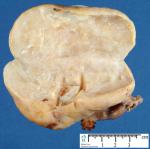 ovarian_fibroma_10_2.jpg